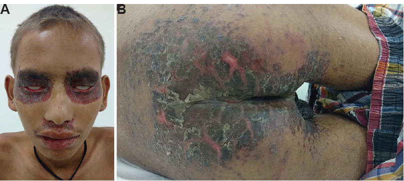 (A) Well-demarcated, erythematous, scaly, crusted plaque over the periocular, perioral region. Scalp hairs were hypopigmented, dry and brittle. (B) Erythematous, thick scaly, crusted plaque over the perianal region, extending up to lower back.